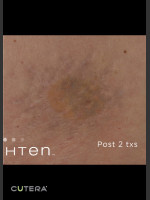 After Photo Tattoo Removal Before & After Photo of Sun - Prejuvenation Before & After
