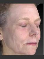 After Photo Wrinkle and Brown Spot Reduction - Prejuvenation Before & After