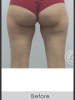 Before Photo CoolSculpting+ for Banana Roll (Under Buttock Roll) - Prejuvenation Before & After