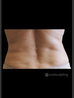 After Photo CoolSculpting Before & After on Woman - Prejuvenation Before & After