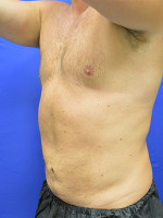 After Photo Liposuction Case #1 - Prejuvenation Before & After