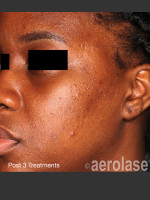 After Photo NeoClear by Aerolase Acne Treatment - Prejuvenation Before & After