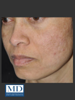 After Photo Melasma Face Treatment 117 - Prejuvenation Before & After
