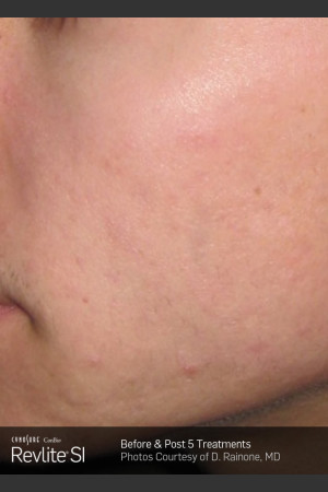 revlite for acne