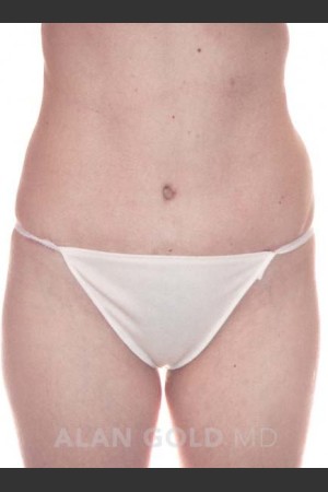 After Photo for Abdominoplasty 286 - Alan Gold MD - Prejuvenation