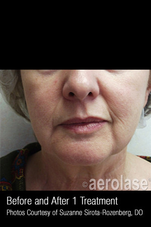 Before Photo for Skin Tightening #342 -  - Prejuvenation