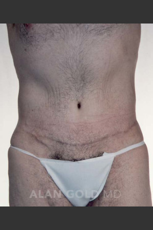 After Photo for Abdominoplasty 320 - Alan Gold MD - Prejuvenation