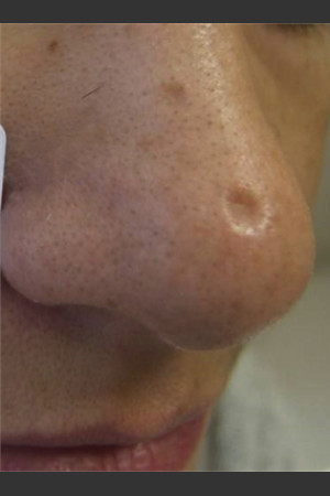 Treatment of Nose Acne Scar - Prejuvenation