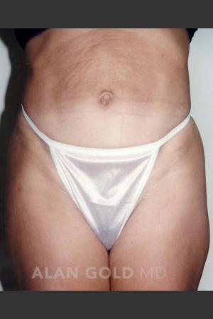 Before Photo for Abdominoplasty 279 - Alan Gold MD - Prejuvenation