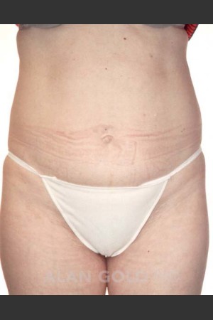 Before Photo for Abdominoplasty 286 - Alan Gold MD - Prejuvenation