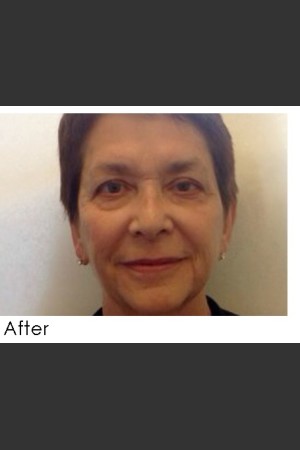 After Photo