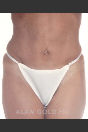 After Photo for Abdominoplasty 279 - Alan Gold MD - Prejuvenation