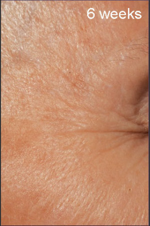 After Photo for DefenAge Clinical Power Trio -  - Prejuvenation