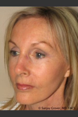 After Photo