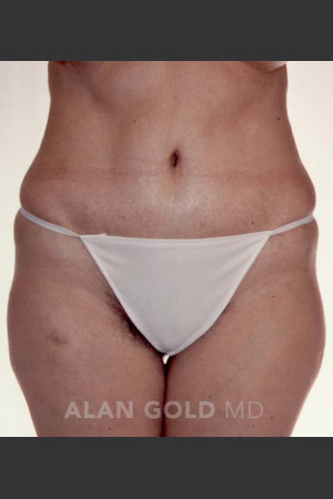 After Photo for Abdominoplasty 293 - Alan Gold MD - Prejuvenation