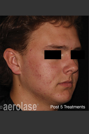 After Photo for NeoClear by Aerolase Acne Treatment - Amy Forman Taub, MD - Prejuvenation