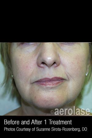 After Photo for Skin Tightening #342 -  - Prejuvenation