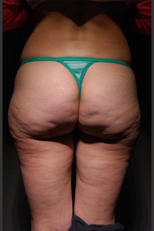 Before Photo for Cellfina Case #2 - South Coast Plastic Surgery - Prejuvenation