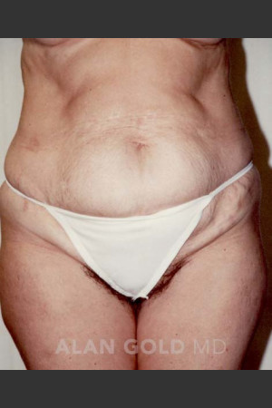 Before Photo for Abdominoplasty 293 - Alan Gold MD - Prejuvenation