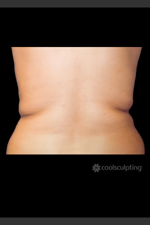 Before Photo for CoolSculpting Before & After on Woman -  - Prejuvenation
