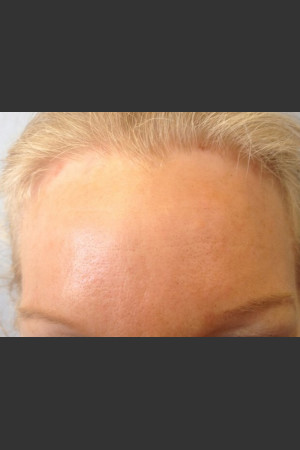 After Photo for Before & After Botox - Janell Ocampo - Prejuvenation