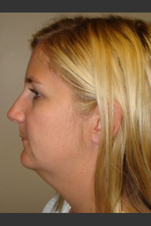 Before Photo