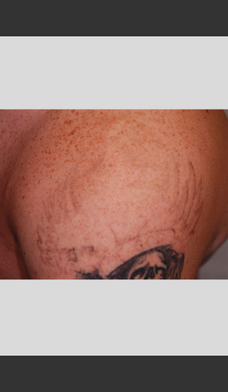After Photo for PicoWay Tattoo Removal on Shoulder  -  - Prejuvenation