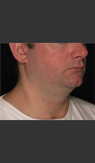 Before Photo for Treatment of Neck Contour -  - Prejuvenation