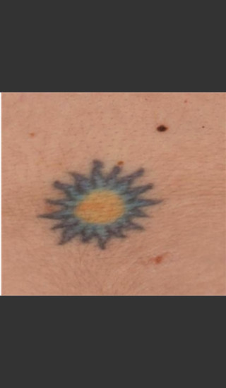 Before Photo for Treatment of Tattoo -  - Prejuvenation