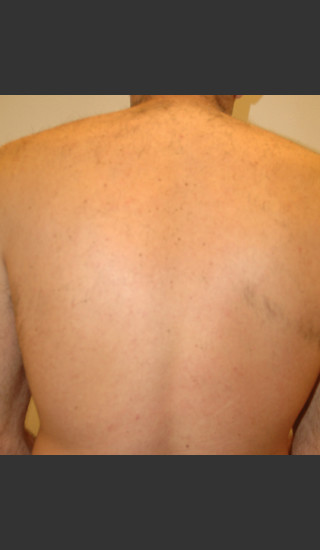 After Photo for Laser Hair Removal - James Newman - Prejuvenation