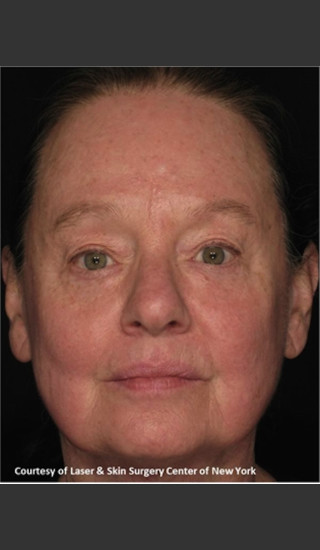 After Photo for Treatment of Facial Pigmentation -  - Prejuvenation