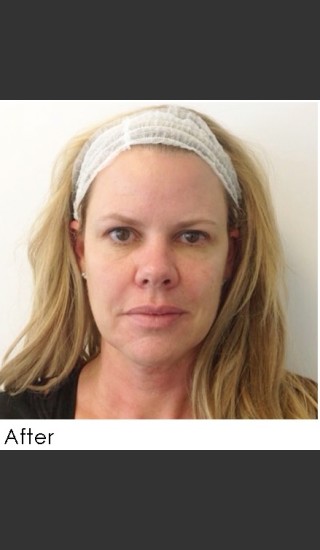 After Photo for Sculptra Facial Rejuvenation - Annie Chiu, MD - Prejuvenation