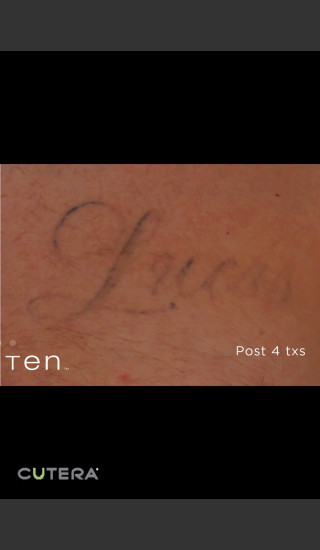 After Photo for Tattoo Removal Before & After Photo 