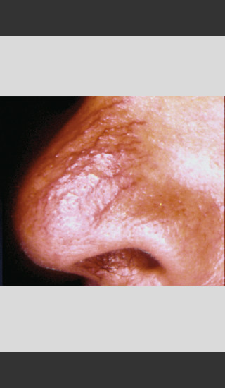 Before Photo for Vbeam Laser Treatment of Nose Veins -  - Prejuvenation