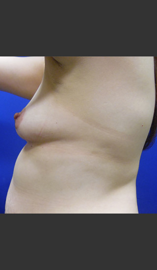 Before Photo for Breast Augmentation Case #1 - Paul C. Dillon, MD - Prejuvenation