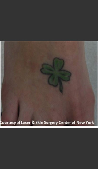 Before Photo for Treatment of Foot Tattoo -  - Prejuvenation