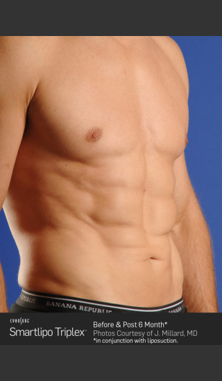After Photo for Smartlipo High Def Laser Lipo -  - Prejuvenation