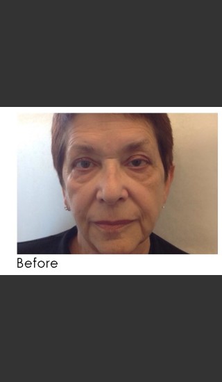Before Photo for Radiesse and Restylane Filler Treatment - Annie Chiu, MD - Prejuvenation