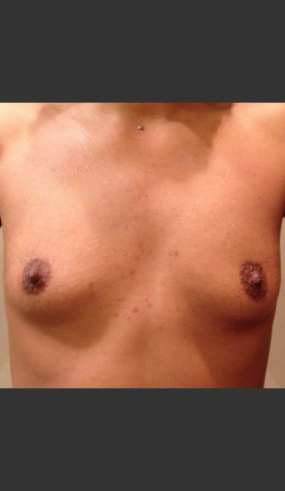 Before Photo for Dr. Palmer Breast Augmentation 02 - Shane Palmer - Prejuvenation