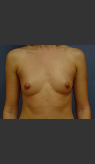 Before Photo for Breast Augmentation - Michael S. Beckenstein, MD - Prejuvenation