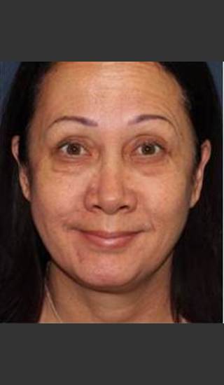 After Photo for Crow`s Feet Reduction - Kimberly J. Butterwick M.D. - Prejuvenation