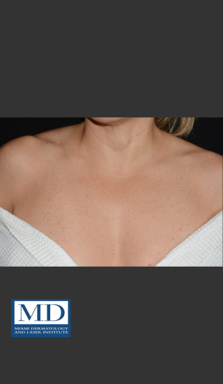 After Photo for IPL Brown Spots Treatment 108 - Jill S. Waibel, MD - Prejuvenation