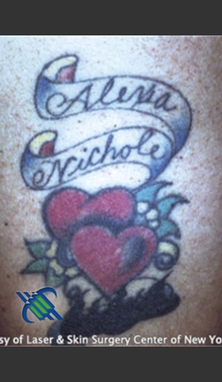Before Photo for Treatment of Arm Tattoo - Roy G. Geronemus, M.D. - Prejuvenation