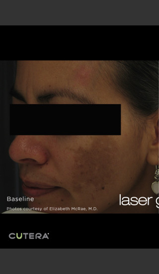 Before Photo for Melasma Before & After Photo after Laser Genesis -  - Prejuvenation