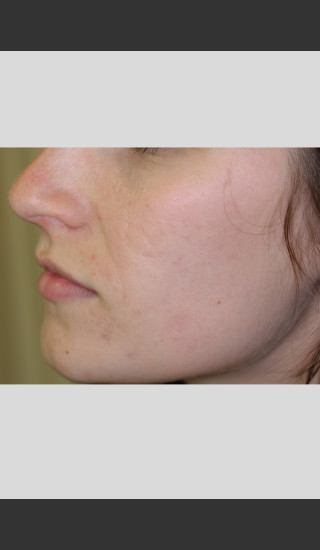 After Photo for Sublative Rejuvenation Treatment -  - Prejuvenation