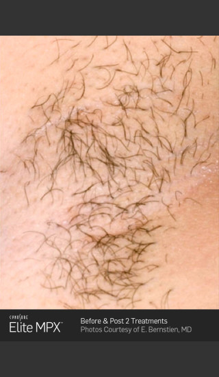 Before Photo for Hair Removal of Under Arms with Elite MPX -  - Prejuvenation