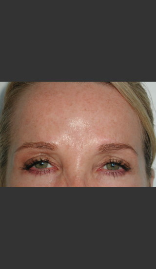 After Photo for Serene Procedure (Nuebelle) - James Newman - Prejuvenation