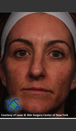 Before Photo for Full Face Skin Rejuvenation - Roy G. Geronemus, M.D. - Prejuvenation