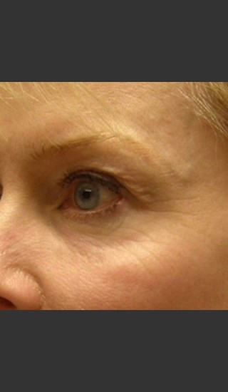 Before Photo for Dr. Langdon ThermiSmooth  - Robert Langdon - Prejuvenation