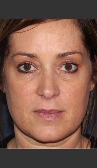 Before Photo for Lip Augmentation - Douglas Wu, M.D. - Prejuvenation